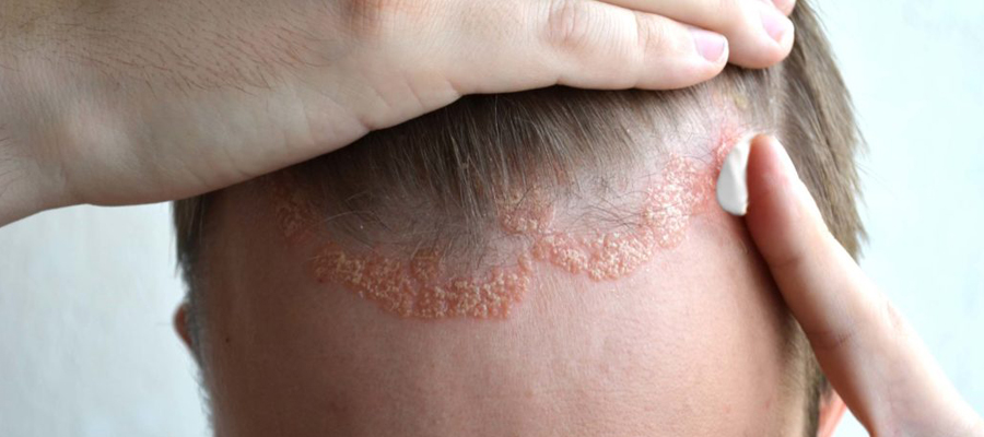 psoriasis du cuir chevelu